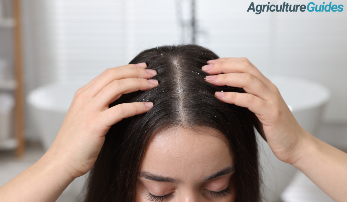 Dandruff Treatment at Home